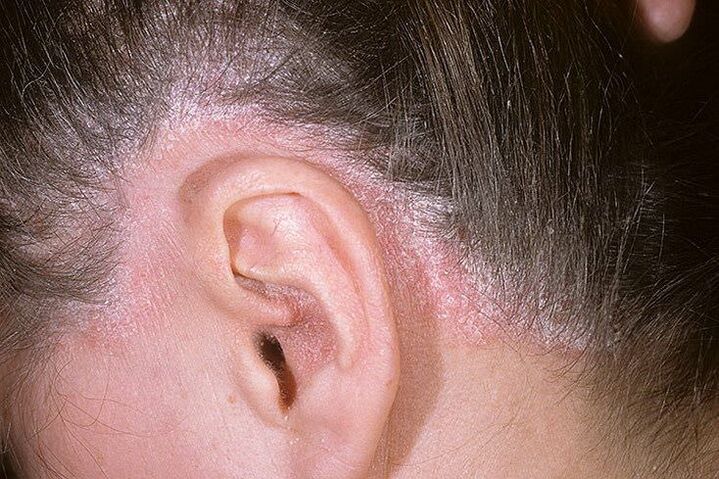 Επιδημίες ψωρίασης στο κεφάλι πίσω από τα αυτιά